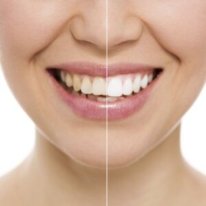 TeethWhitening_Monrovia_Comparison