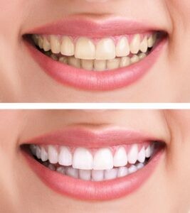 Teeth Whitening Monrovia