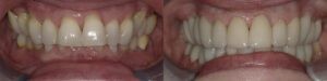 Dr. Q Before and Afters Patient 1a