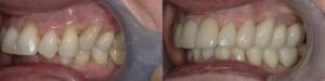 Dr. Q Before and Afters Patient 1c